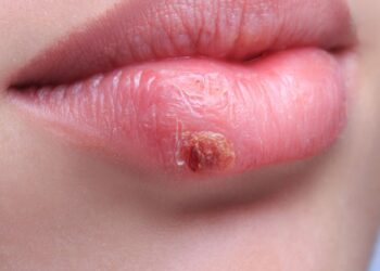 Mais de metade da população tem o vírus do herpes labial