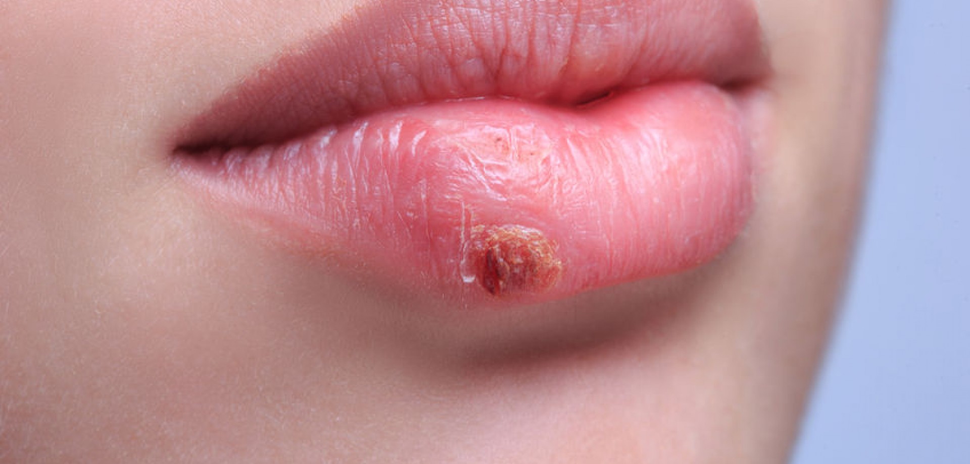 Mais de metade da população tem o vírus do herpes labial