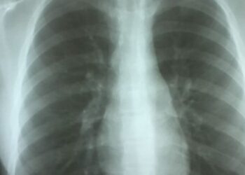 Taxa de incidência da tuberculose no Centro é a mais baixa do País