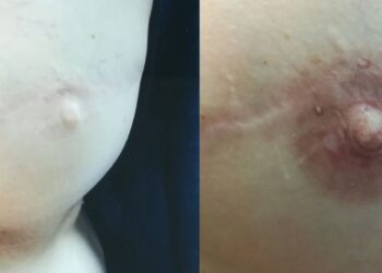 Dermopigmentação melhora auto-estima de vítimas de cancro