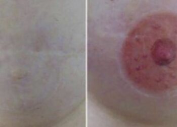 Tatuador faz reconstrução de mamilos a mulheres vítimas de cancro da mama
