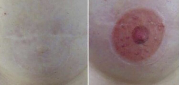 Tatuador faz reconstrução de mamilos a mulheres vítimas de cancro da mama