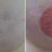 Tatuador faz reconstrução de mamilos a mulheres vítimas de cancro da mama
