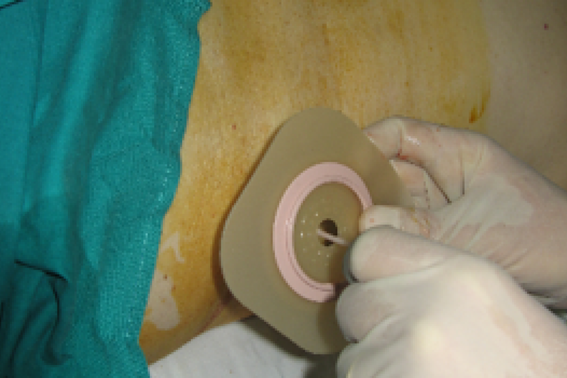 ULS de Leiria assinala Dia Mundial da Pessoa Ostomia