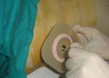ULS de Leiria assinala Dia Mundial da Pessoa Ostomia