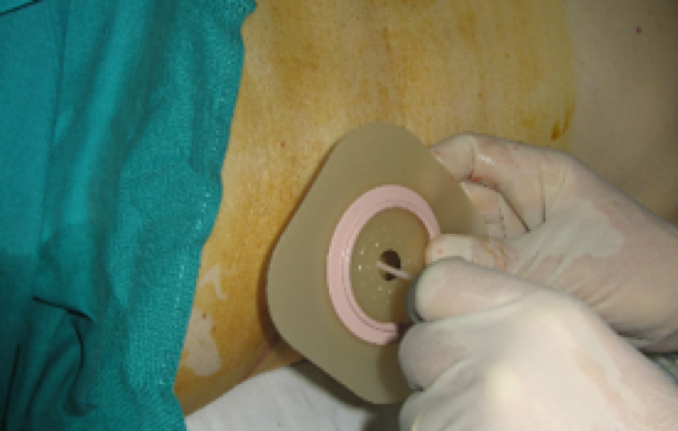 ULS de Leiria assinala Dia Mundial da Pessoa Ostomia