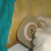 ULS de Leiria assinala Dia Mundial da Pessoa Ostomia