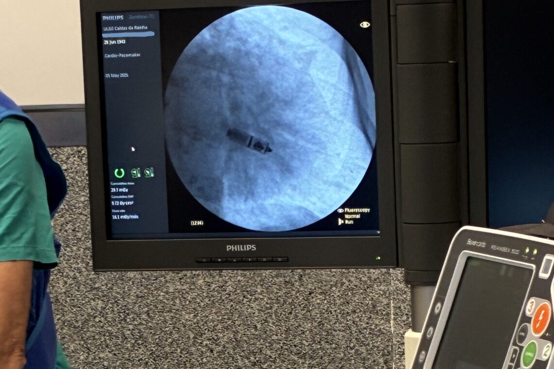 Hospital de Caldas da Rainha inicia prática de implantação de pacemakers