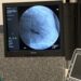 Hospital de Caldas da Rainha inicia prática de implantação de pacemakers