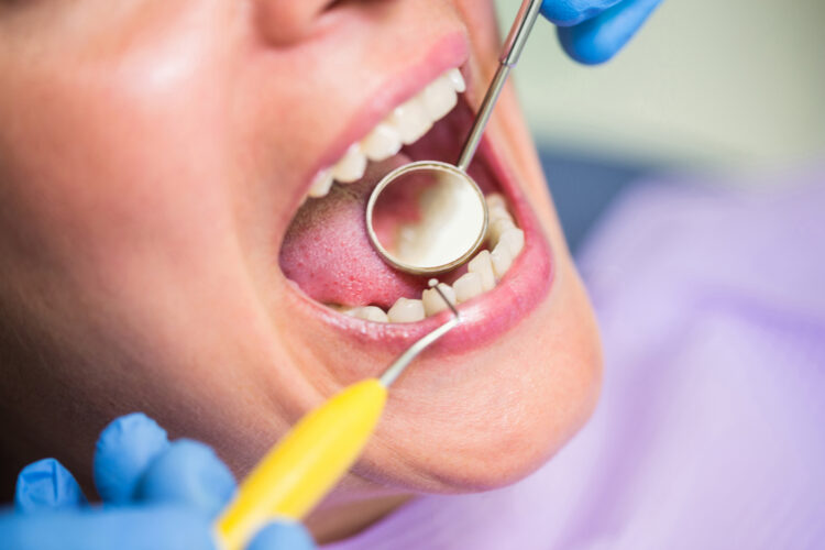 Projecto custeará tratamento de cáries, "em complemento" ao cheque-dentista